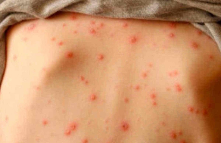 Reino Unido sale de la lista de países libres de sarampión