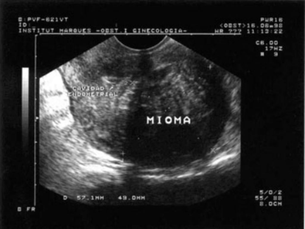 Los miomas uterinos se pueden controlar de forma natural