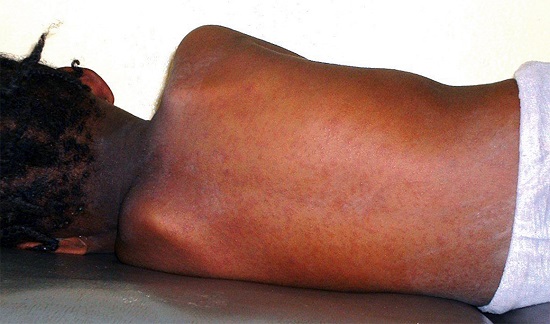 El sarampión ha cobrado la vida de unas cuatro mil personas en Congo