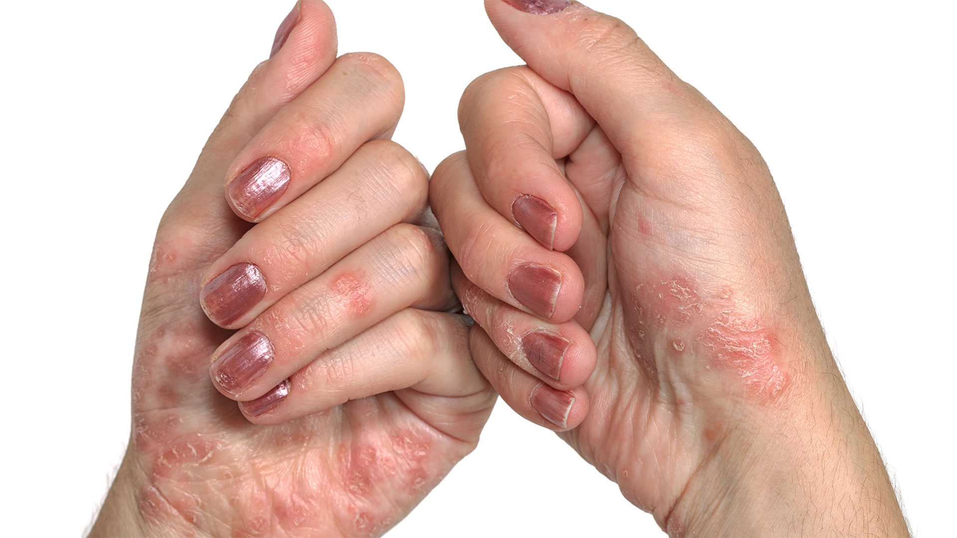 ¿Qué es la Psoriosis ?