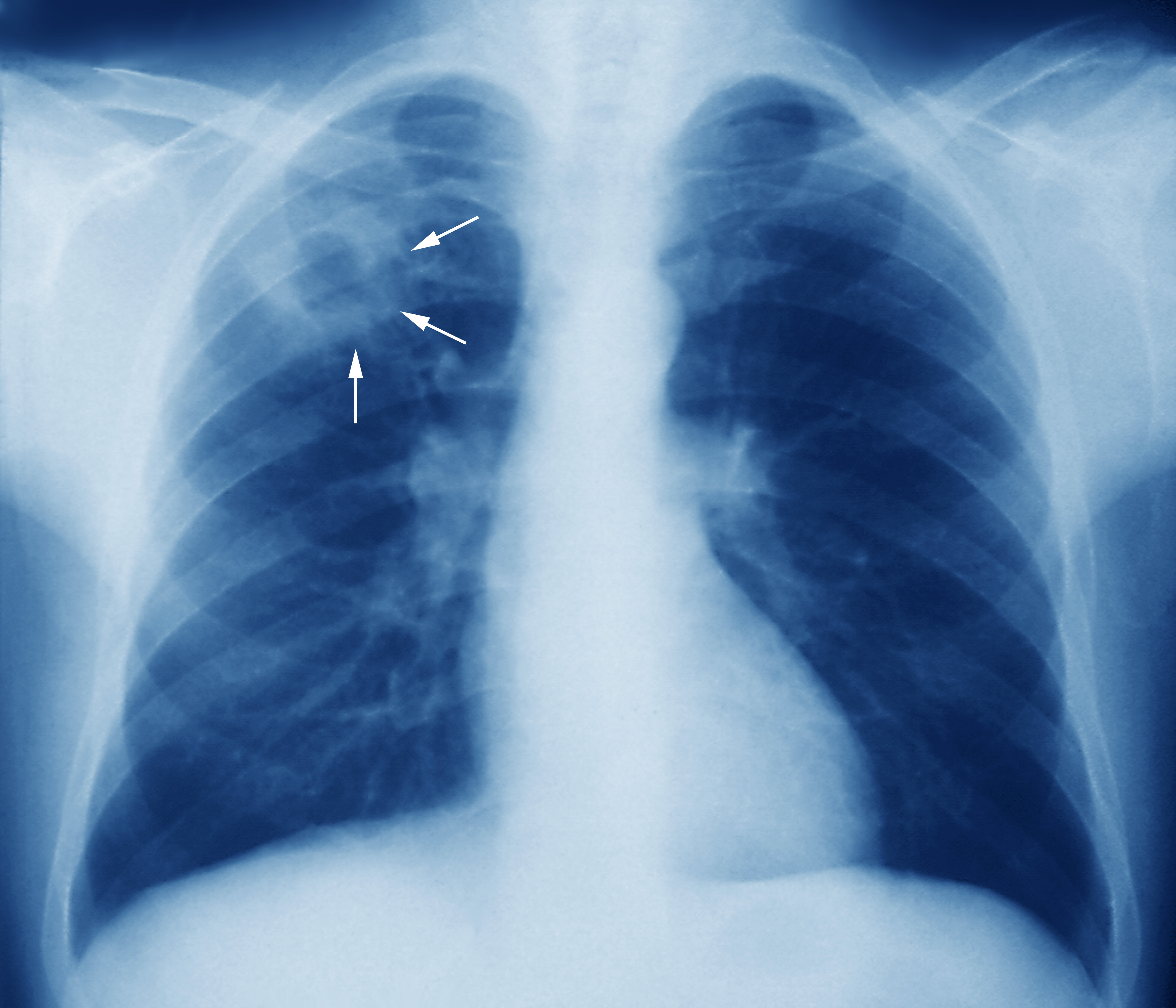 Honduras, entre los países de Latinoamérica con más casos de tuberculosis