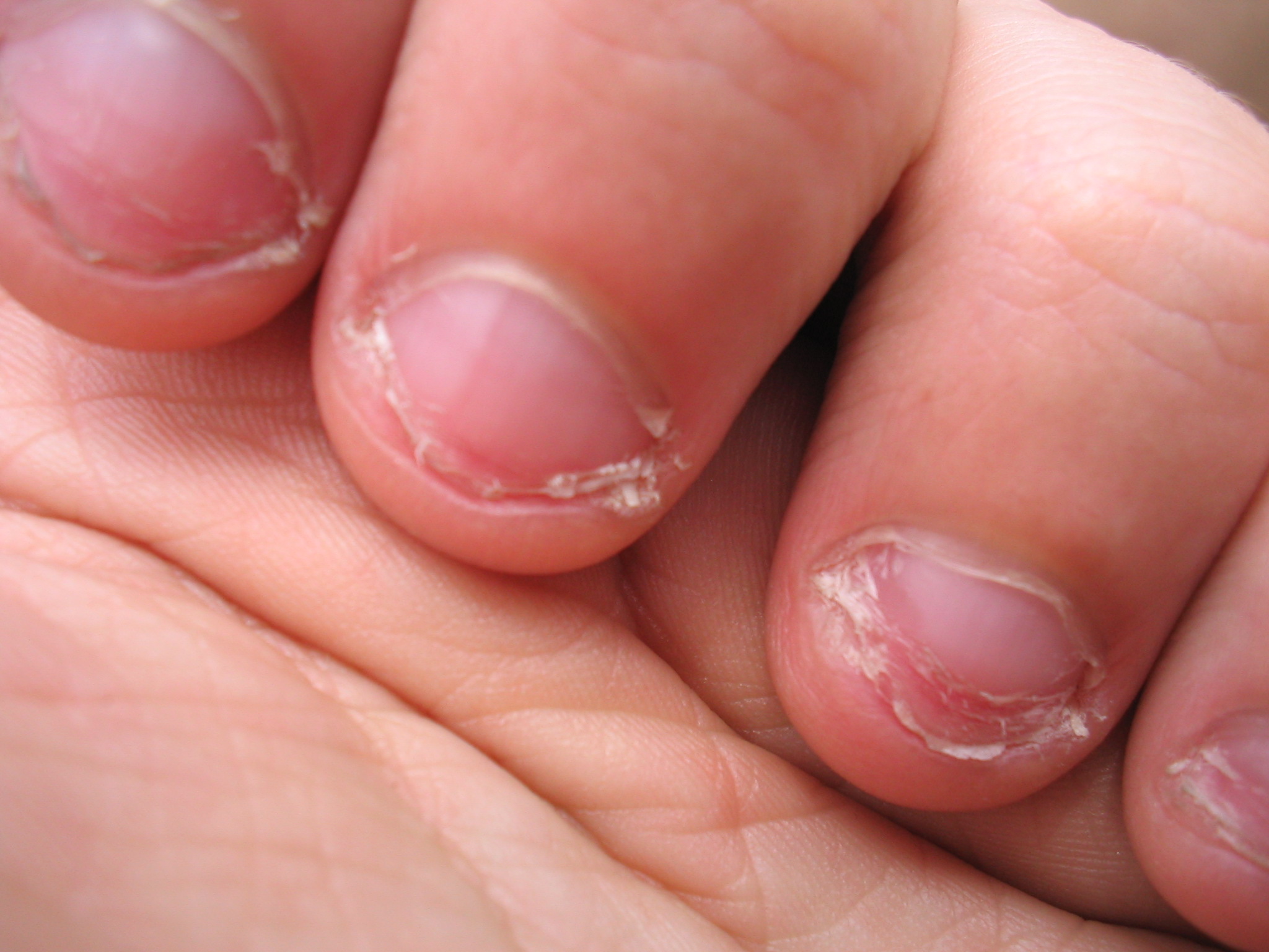 Comerse las uñas: qué se esconde detrás de este mal hábito