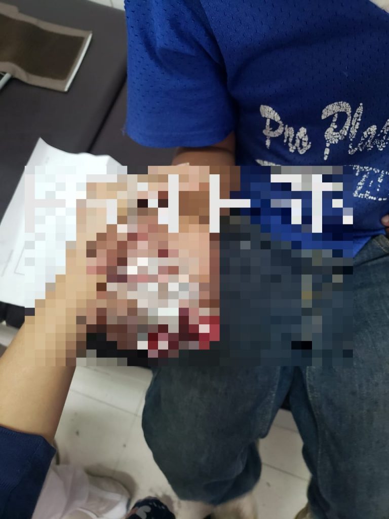 Niños con quemaduras 