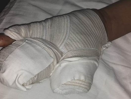 Amputan dedos a menor afectado por pólvora, previo a la temporada navideña