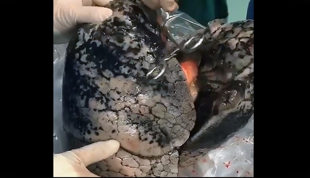 Video: Pulmones negros de hombre que fumó una cajetilla diaria