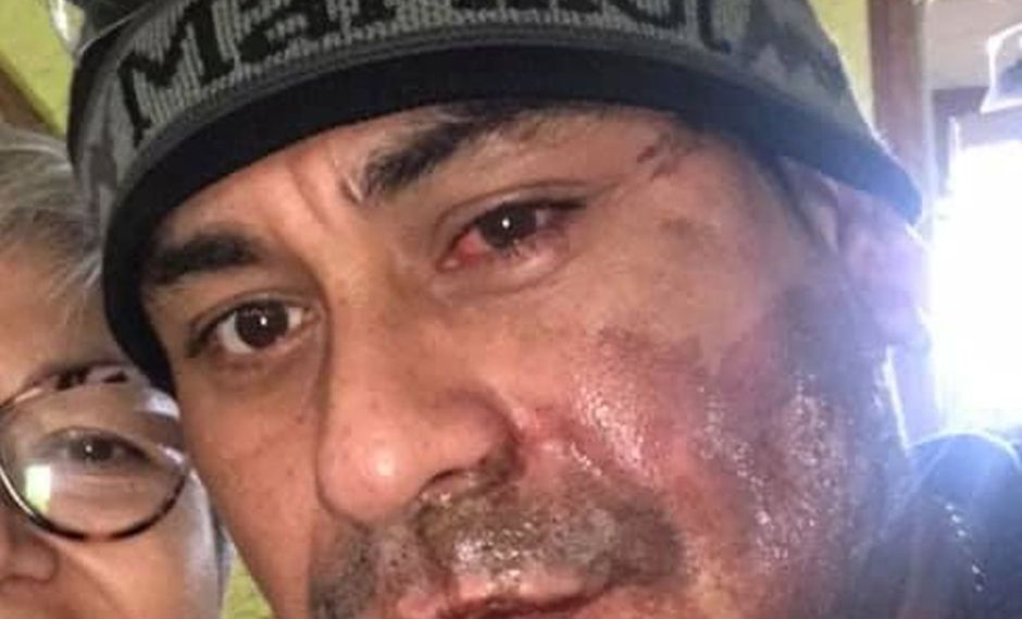 Lanzan ácido de batería a migrante  en ataque racista en Estados Unidos [VIDEO]