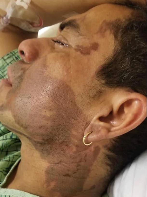 Lanzan ácido de batería a migrante  en ataque racista en Estados Unidos [VIDEO]