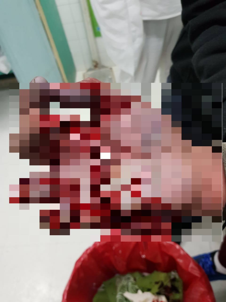 Al menos tres menores resultaron con quemaduras y amputaciones, en Nochebuena
