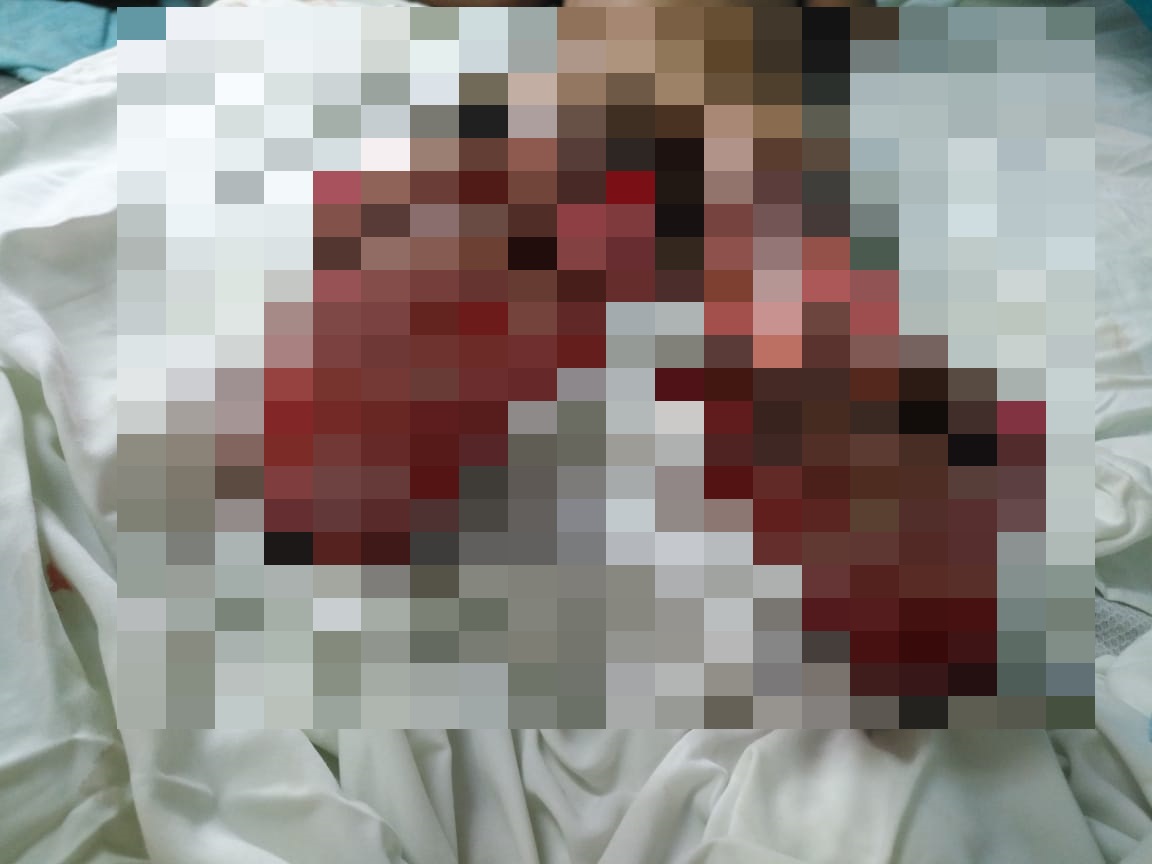 Menor de 4 años se quema el 96% de su cuerpo tras manipular pólvora en Honduras