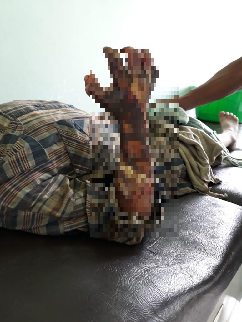 Padre quema el brazo derecho de su hijo, por haberse comido un alimento que no le correspondía