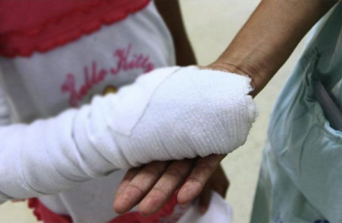 Honduras cerró el 2019 con casi 40 quemados por manipular pólvora