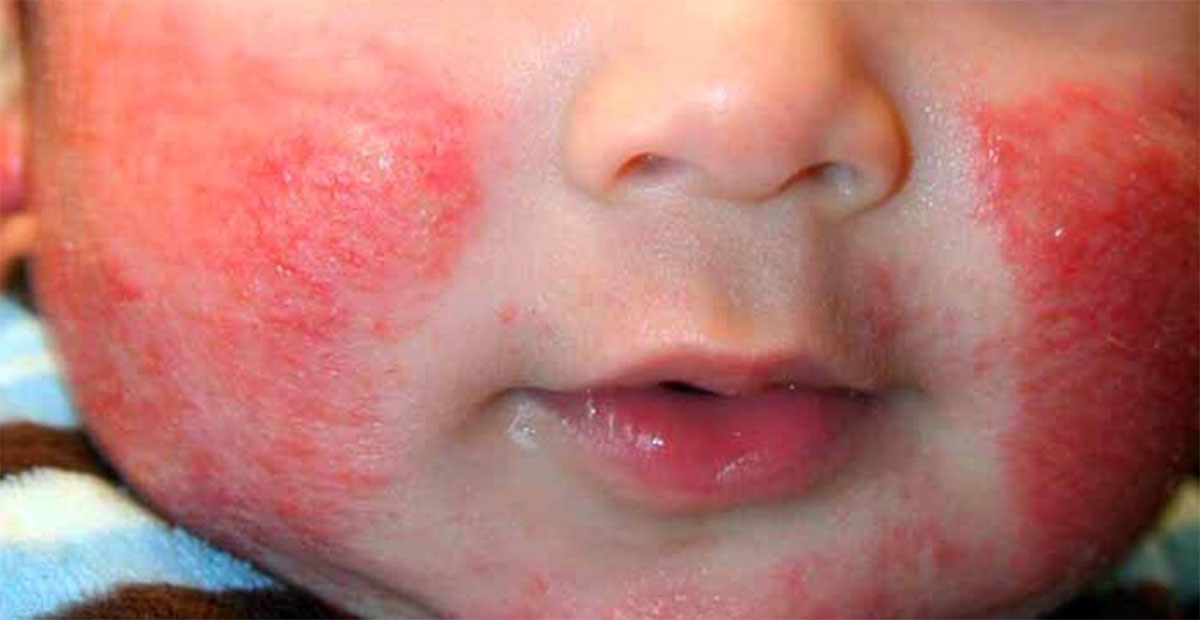 Imagen de Se reportan cinco niños sospechosos de la enfermedad de Kawasaki en Honduras