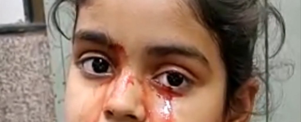 Niña llora lágrimas de sangre y médicos quedan atónitos