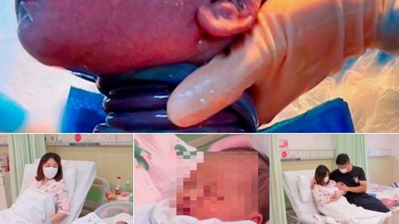Bebé sorprende a médicos al nacer con el cordón umbilical enrollado 6 veces en su cuello