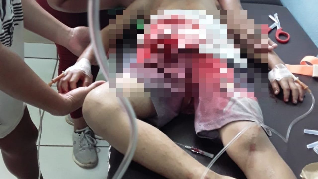 Niño se cortó su estómago accidentalmente con un pedazo de espejo en Santa Cruz de Yojoa