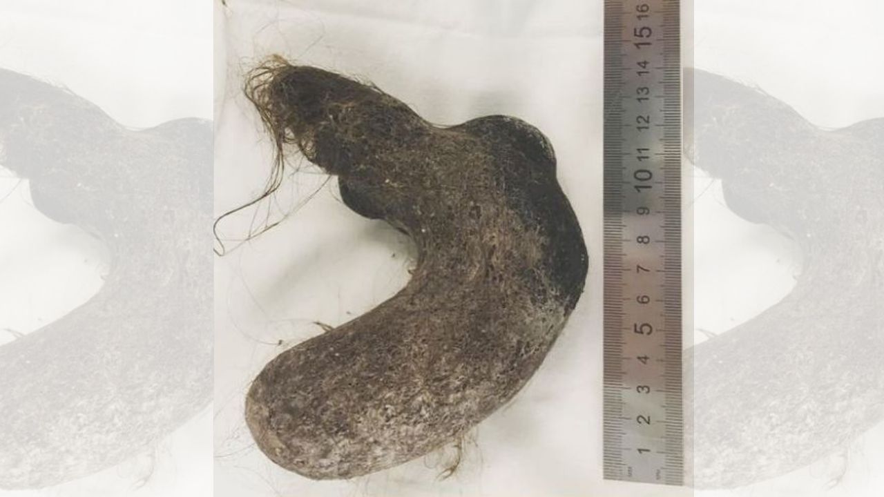 Extraen una bola de pelos de 15 centímetros de largo del estómago de una niña de 12 años