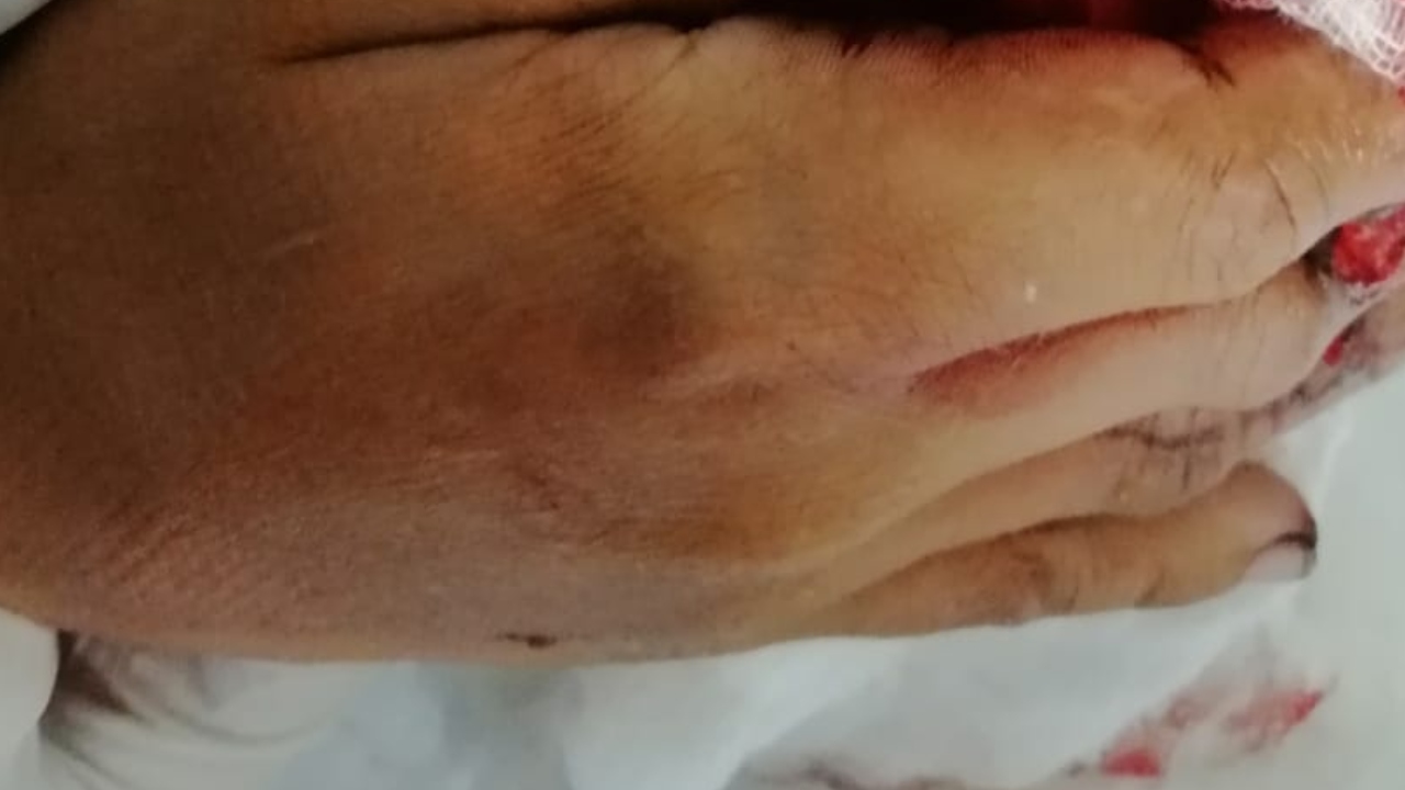 Menor de edad pierde parte de sus dedos al quemarse con pólvora en Honduras