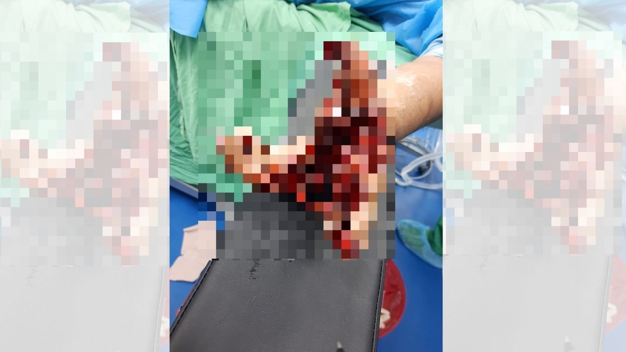 Joven hondureña pierde parte de su mano tras explotarle mortero que se encontró en la calle
