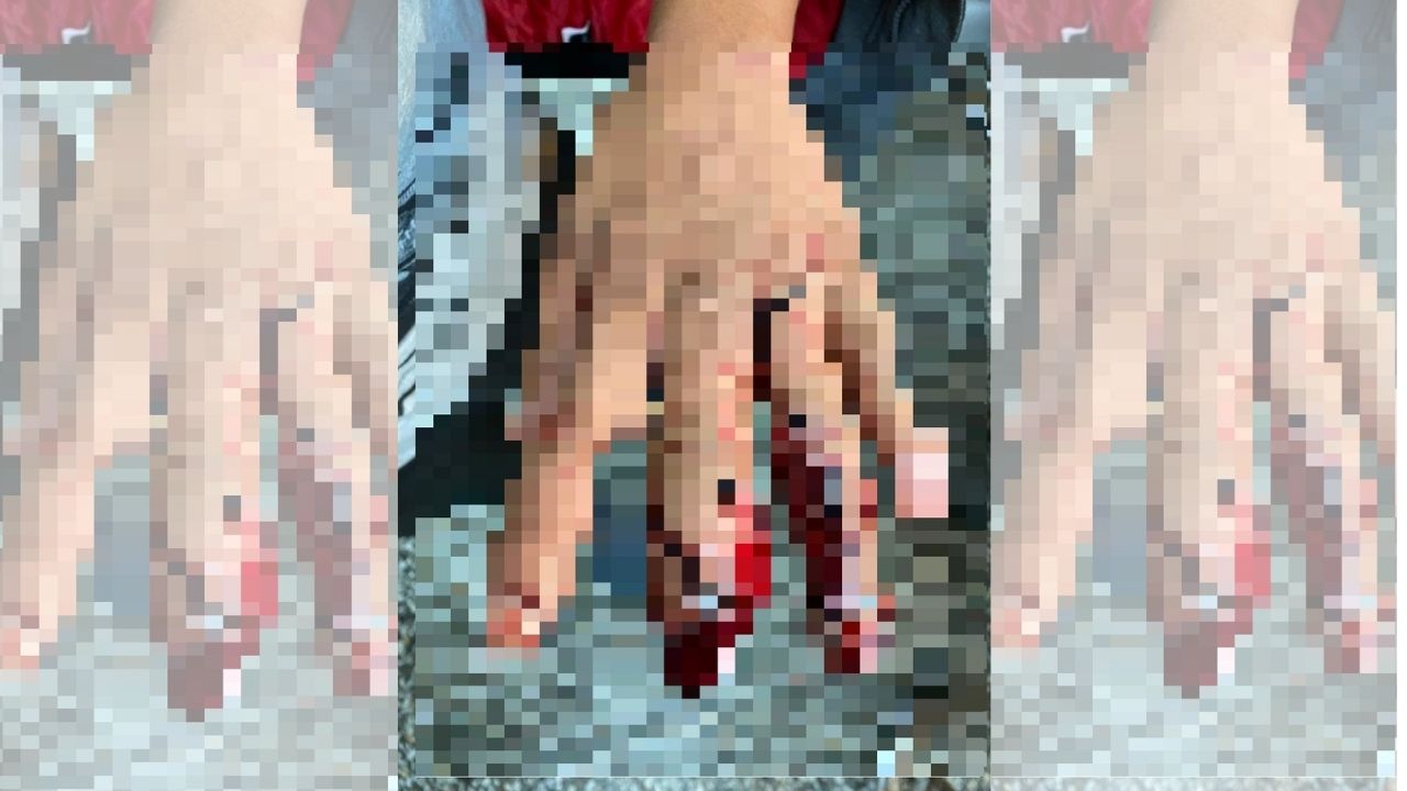 Dos niños entre los cinco quemados por manipulación de pólvora en San Pedro Sula