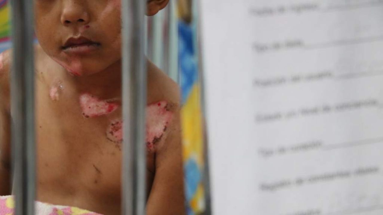 Aumentan los casos de niños quemados por pólvora en Honduras