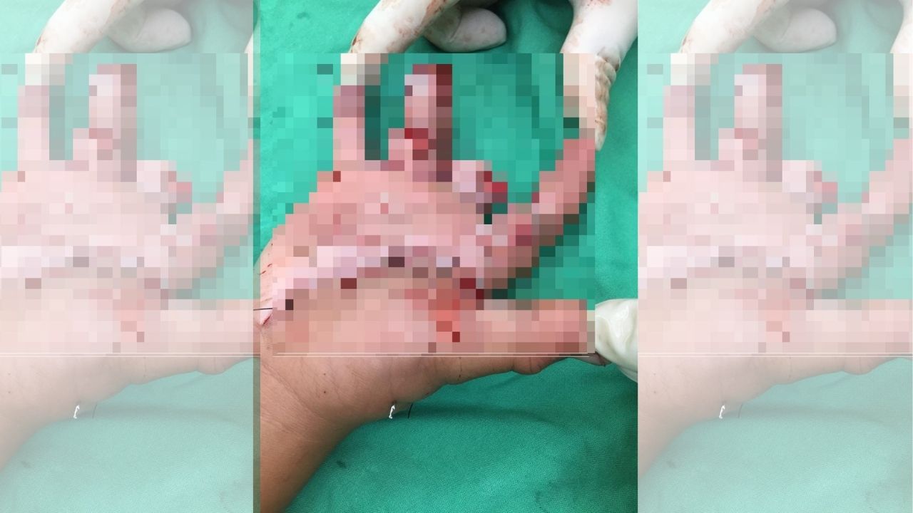 Honduras: Niño de 6 años pierde cuatro dedos al explotarle mortero en la mano