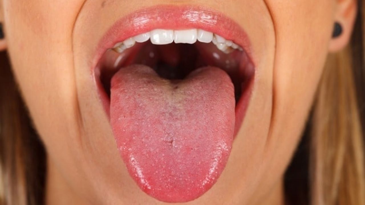 'Lengua covid' es el nuevo síntoma del coronavirus, ¿En qué consiste?