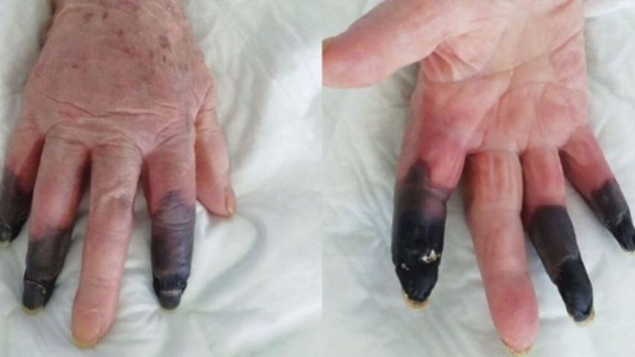 Le amputan tres dedos a una mujer por un nuevo e inesperado efecto secundario del covid-19