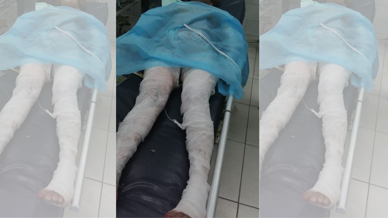 Un menor y tres adultos quemados deja explosión de chimbo de gas en Villanueva, Cortés