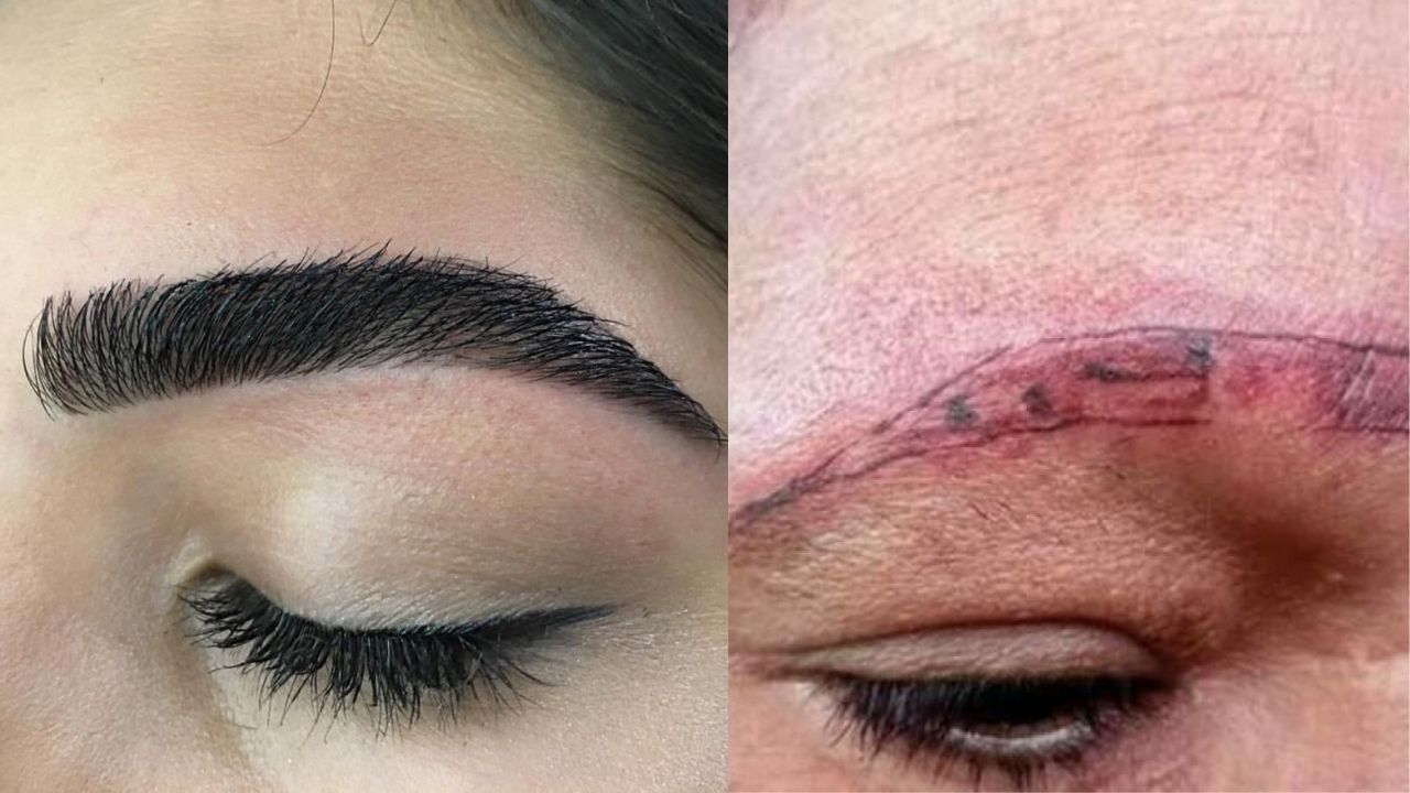 Mujer quedó sin cejas y con una grave quemadura tras realizarse una micropigmentación