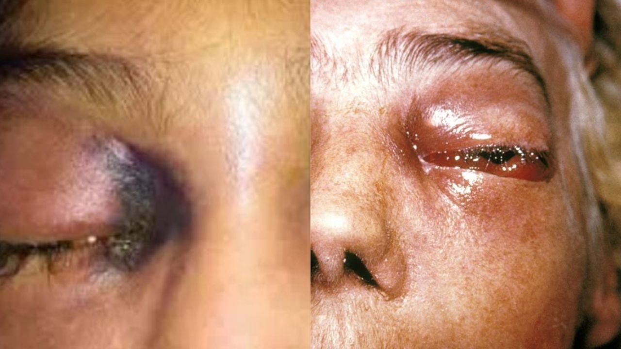 Lo que debe saber sobre el hongo negro que ataca a pacientes con covid