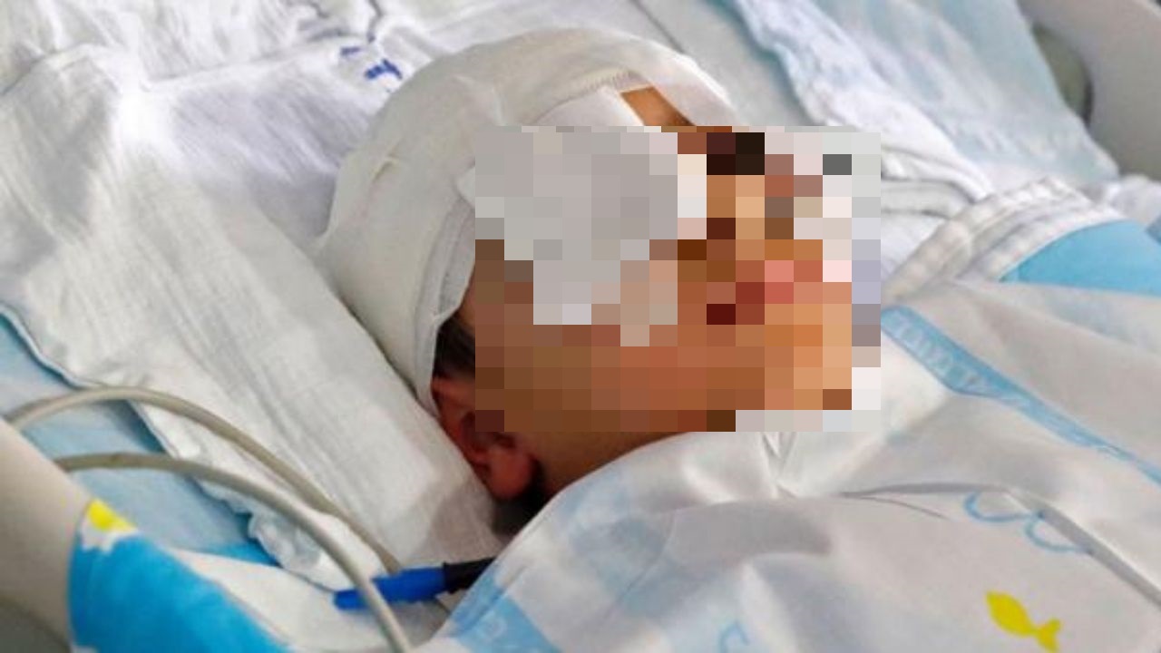 Mujer quemó el rostro de su hijo con una cuchara en Colombia, por esta insólita razón