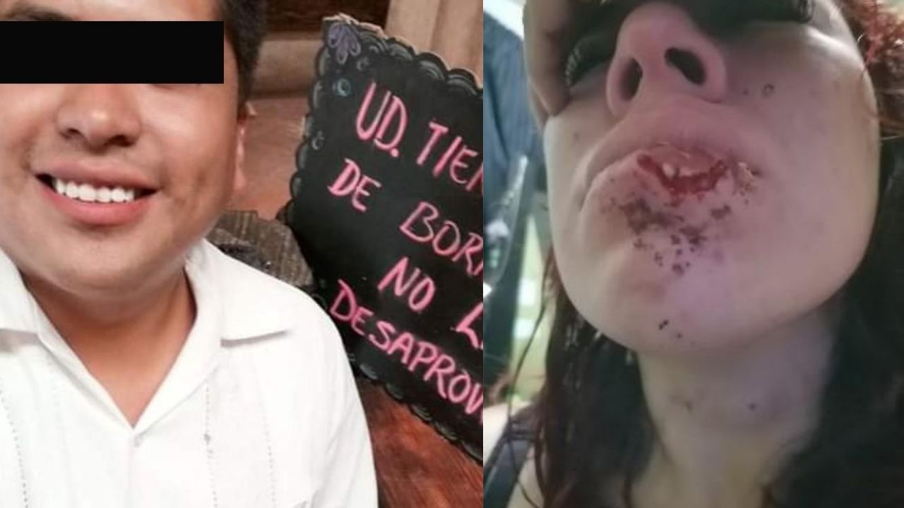 Hombre le arrancó parte del labio inferior a su pareja en un arranque de ira