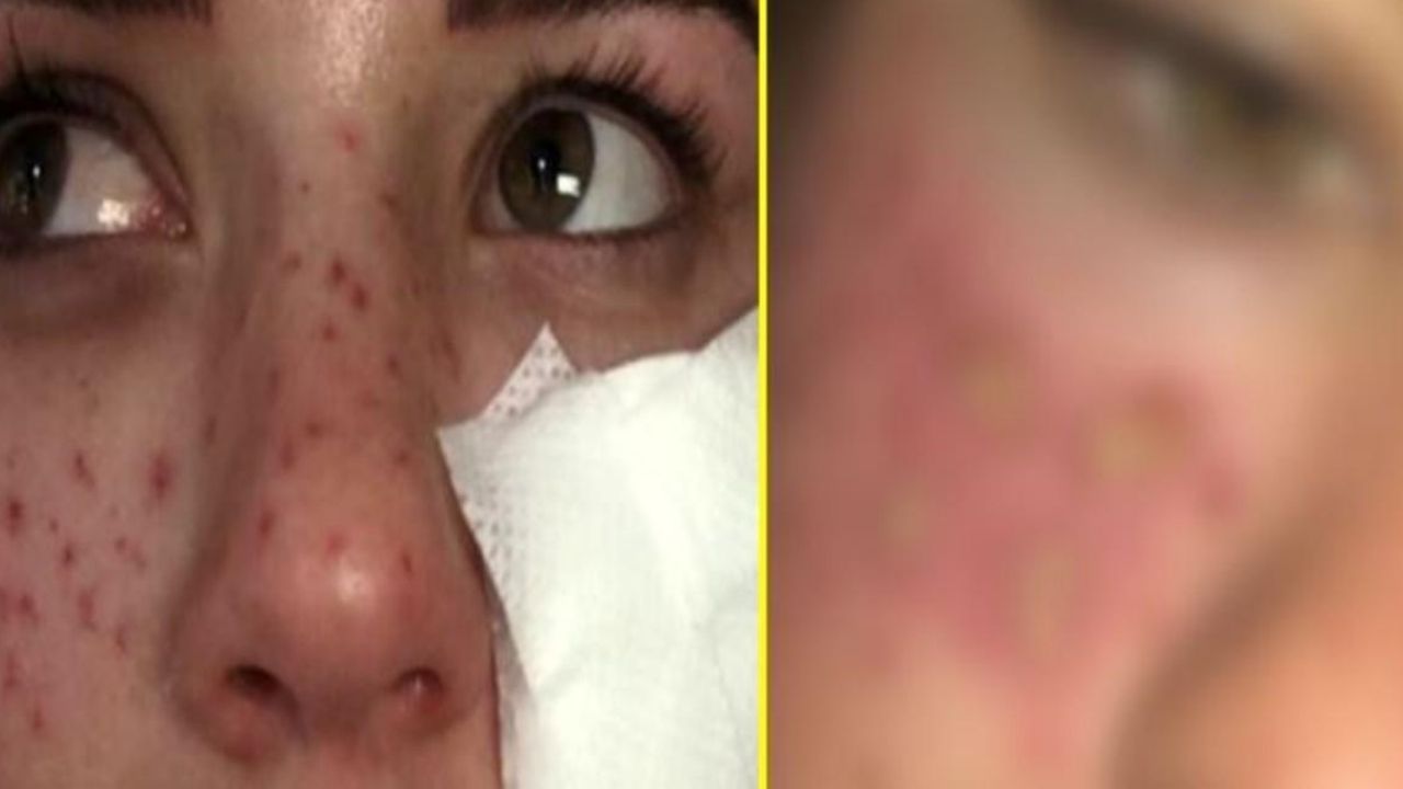 Influencer intentó pintarse pecas y terminó quemada por usar truco casero de Tik Tok
