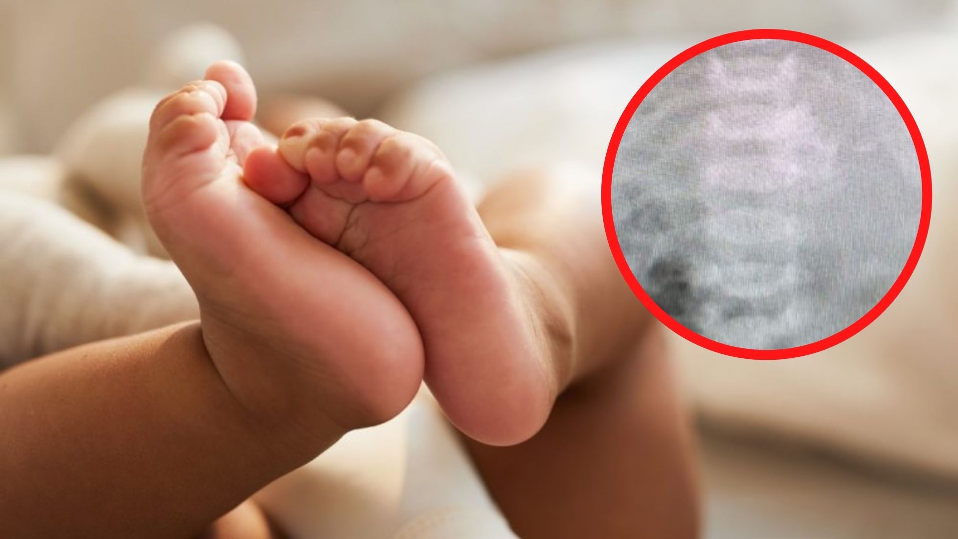 ¡Insólito! Bebé nace con su hermanito gemelo dentro de su  estómago
