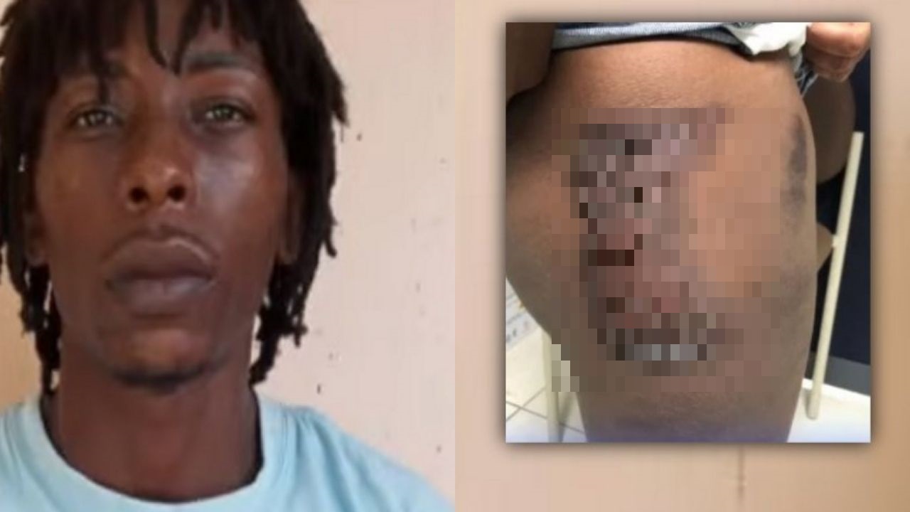 Hondureño roció ácido de batería a su expareja porque no quería regresar con él