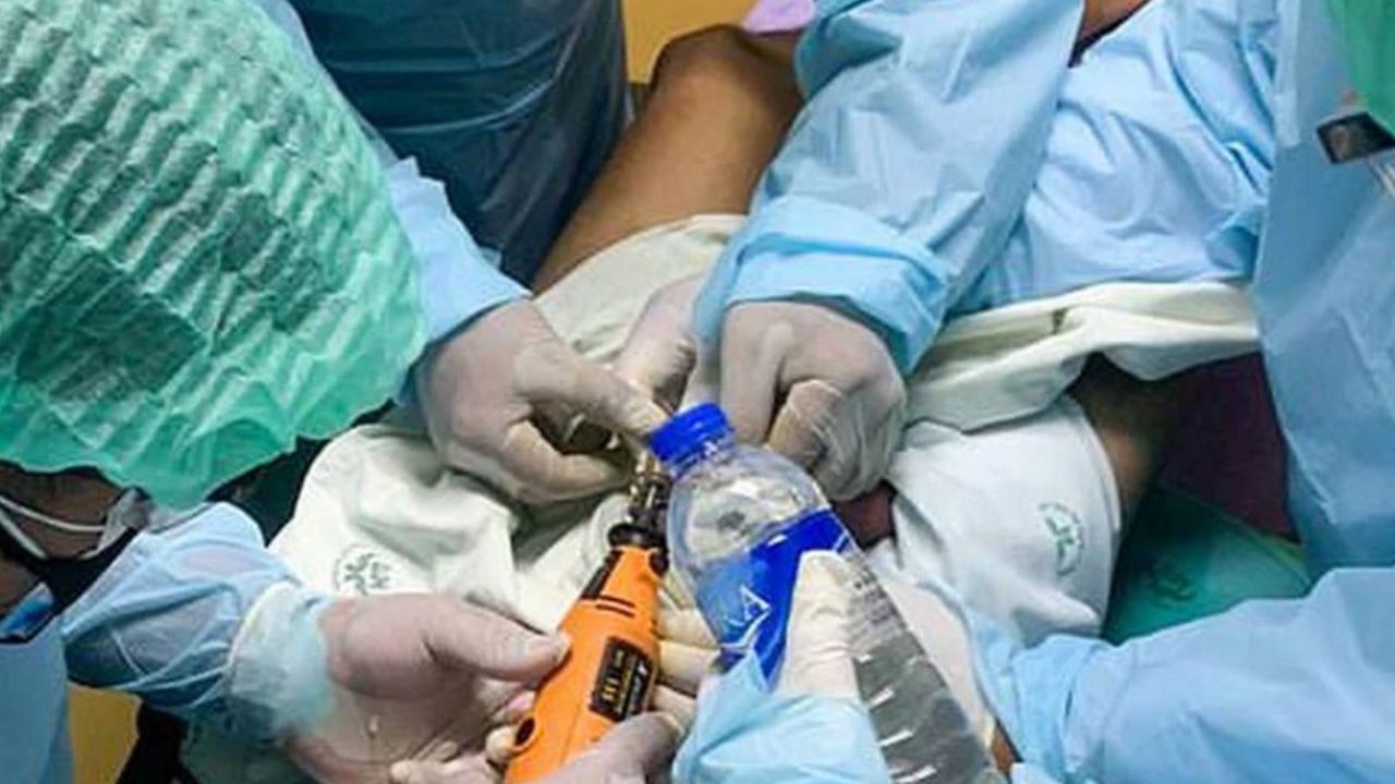 Imagen de Colocó pegamento en sus genitales para evitar embarazar a su ex y murió, aquí el insólito caso