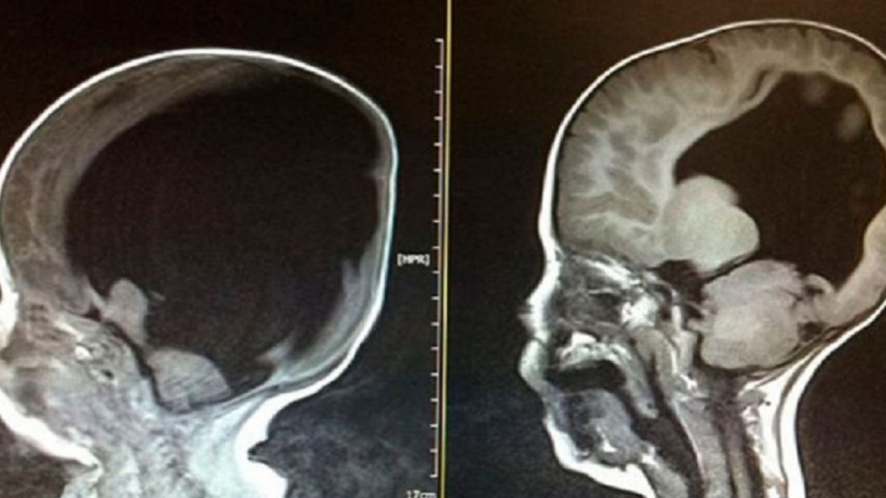 El extraño caso de niño que murió por una ameba comecerebros ¿Cómo y dónde la adquirió?
