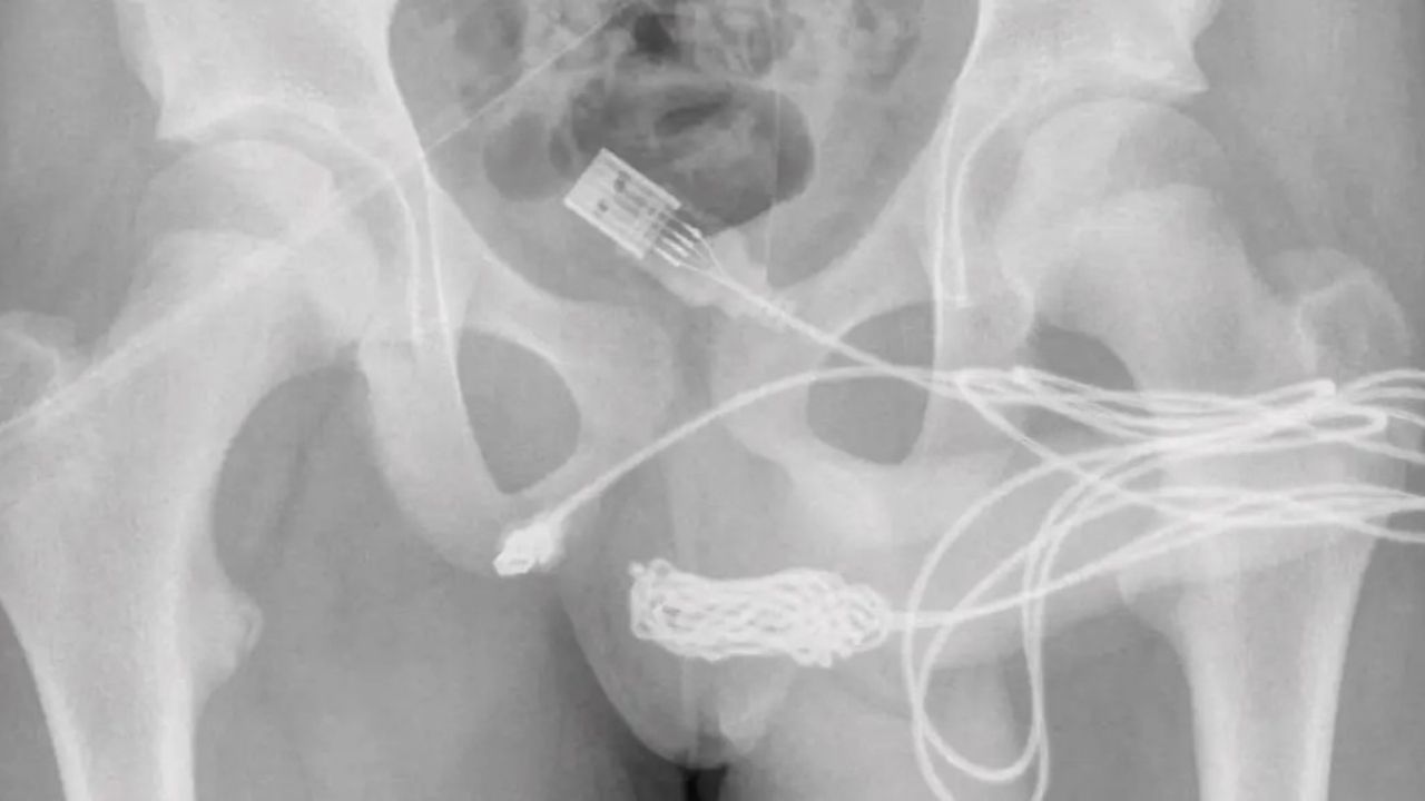 Adolescente fue operado de urgencia tras introducirse un cable USB en su parte íntima