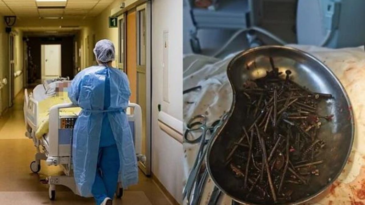 ¡Impactante imagen! Hallan en estómago de hombre tornillos y clavos