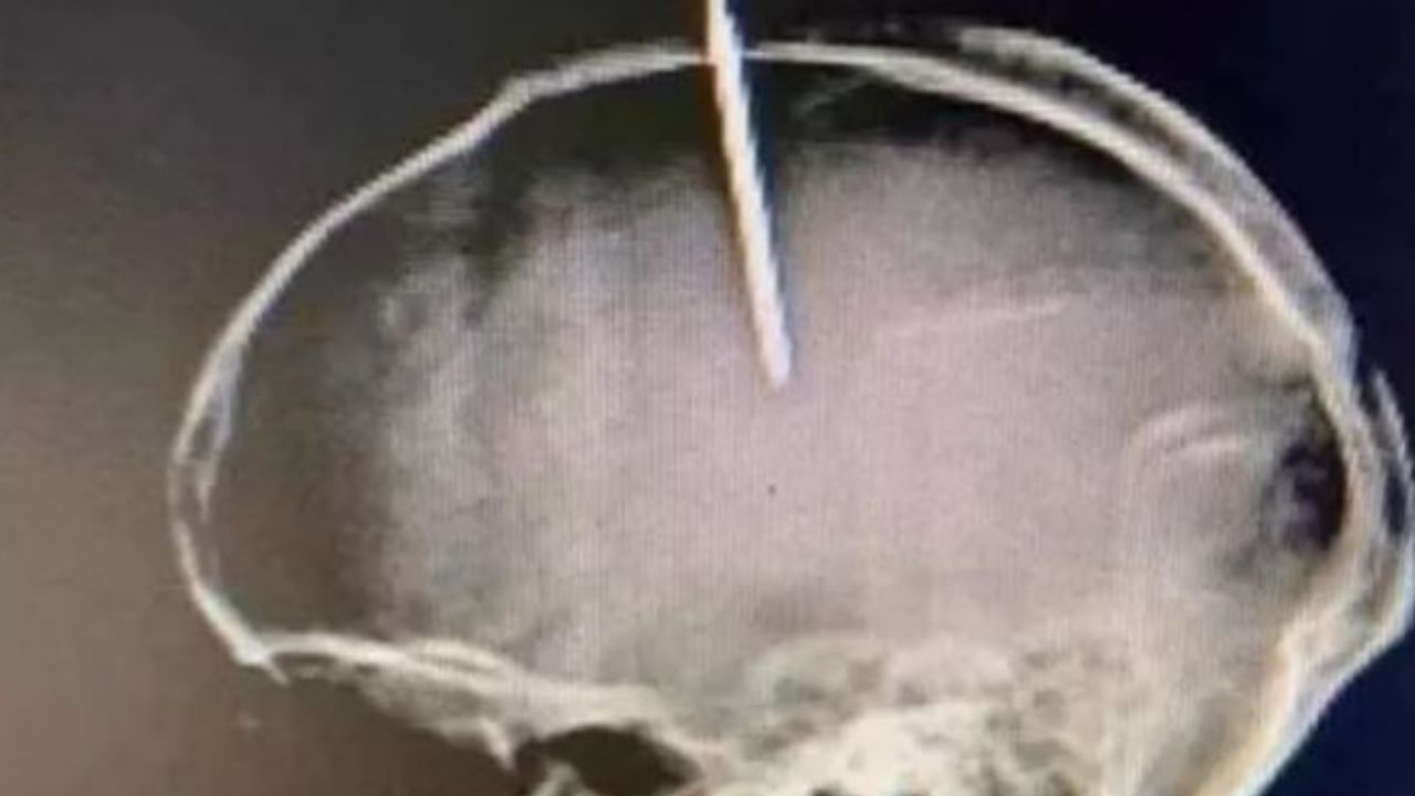 Hombre se incrustó un clavo de seis pulgadas en la cabeza porque sentía el 'cerebro flojo'