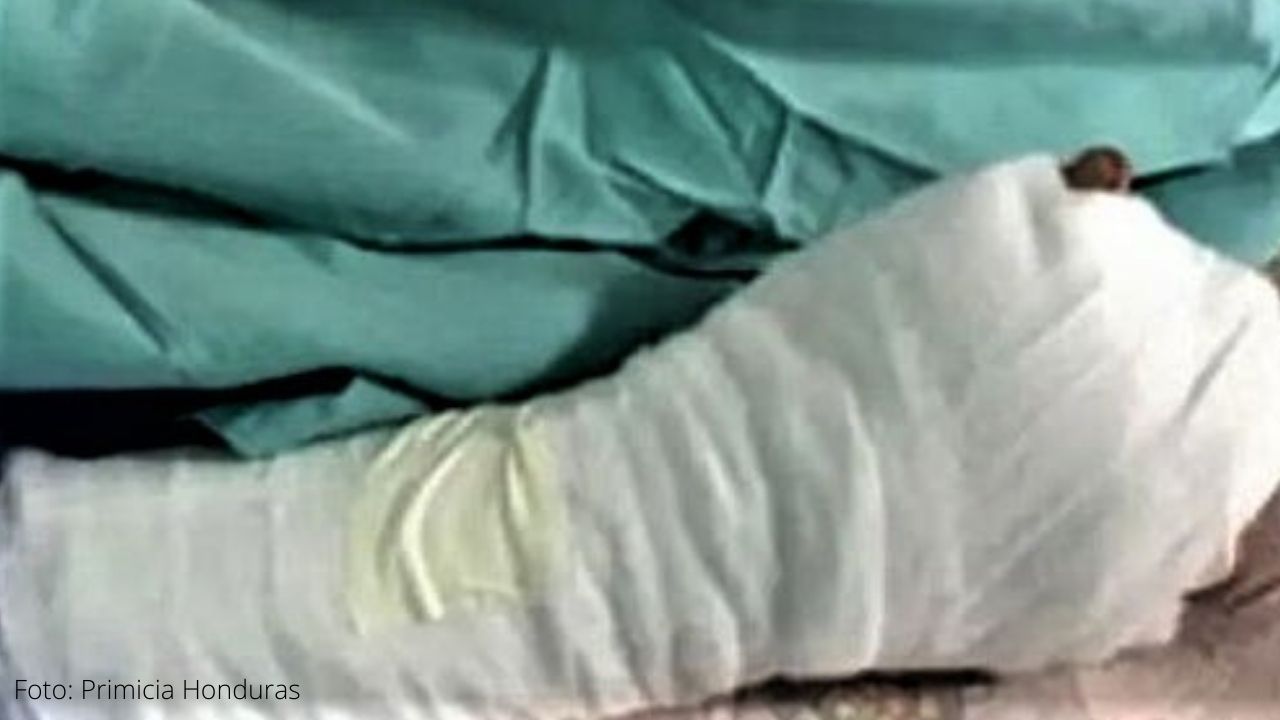 Un menor de 23 meses ingresa a Fundaniquem por quemadura con un 'silbador'