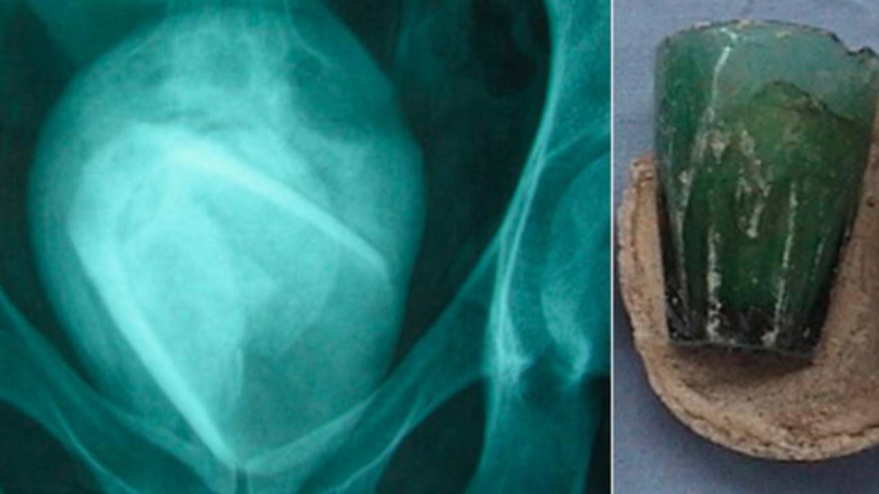 Hallan un vaso de vidrio en la vejiga de una mujer que fue a hospital por 'infección' urinaria