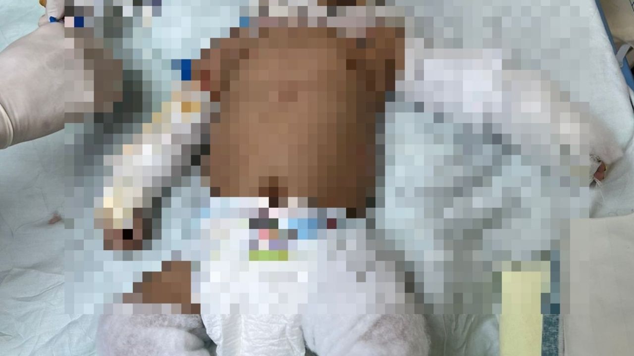 Recién nacido sufre graves quemaduras y está intubada; su madre dejó un candil encendido