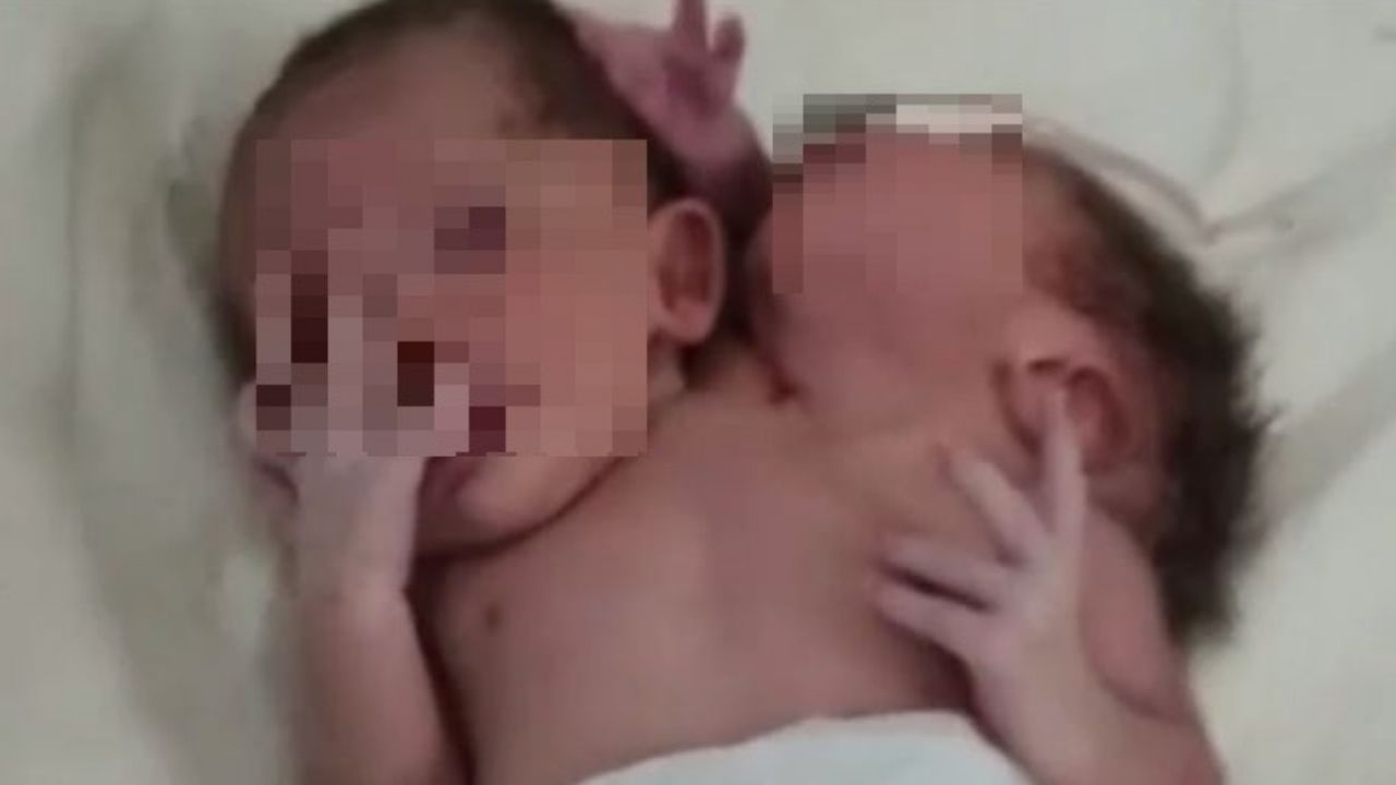 ¡Insólito! Bebé nace con dos cabezas, tres brazos y dos corazones