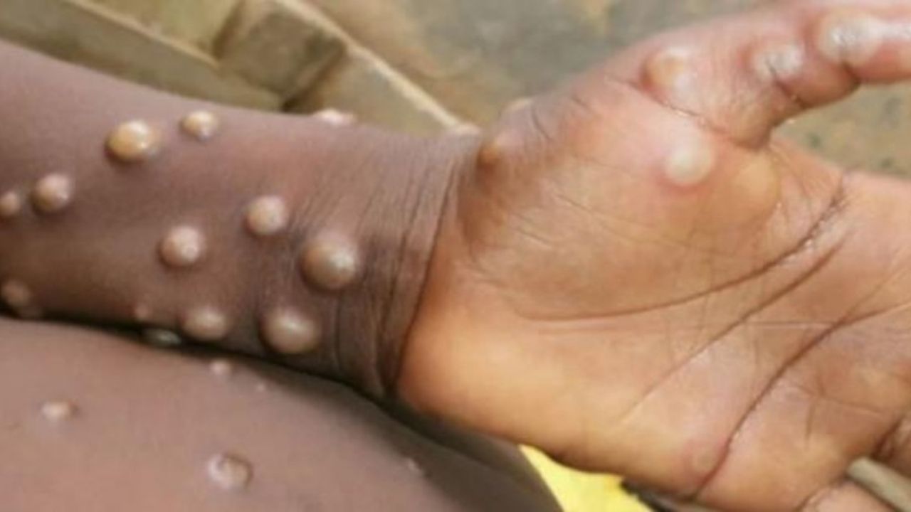 ¿Cuál es la probabilidad de que la viruela del mono llegue a Honduras?, esto es lo que dice el infectólogo Alvarado