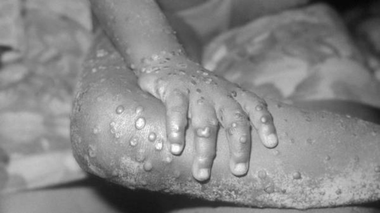 Detectan otros 36 casos de viruela del mono en el Reino Unido