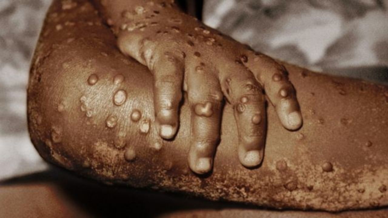 No se descartan que se registren casos de la viruela del mono en Honduras, conoce los síntomas