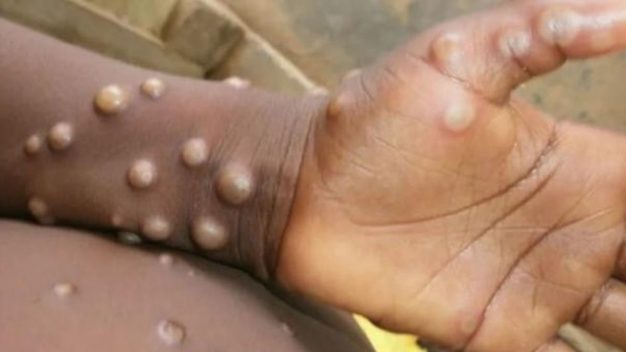 Salud emite alerta epidemiológica por viruela del mono
