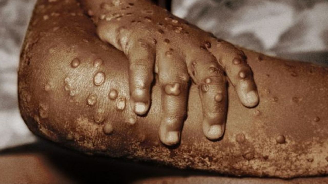 Imagen de Esto dijo la OMS sobre la viruela del mono y el aumento de casos en Europa