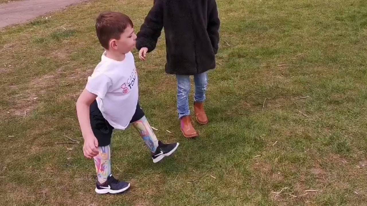 Así es Tony, el niño que perdió sus piernas por torturas de sus padres
